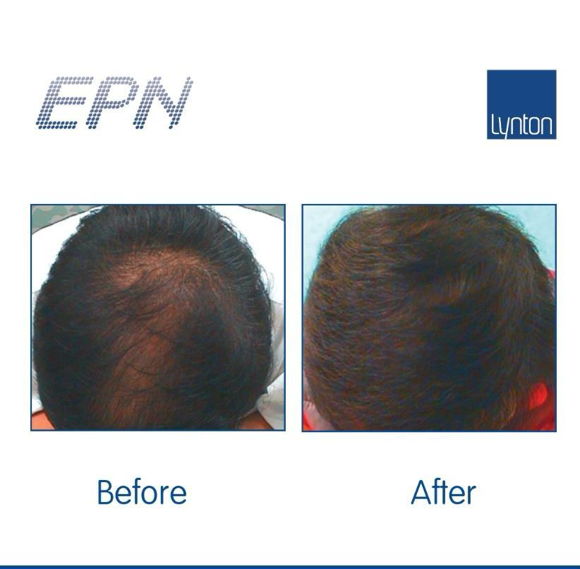 MICRONEEDLING EPN™