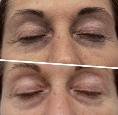ICOONE LASER MED ICOONE LASER MED