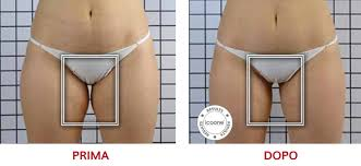 ICOONE LASER MED