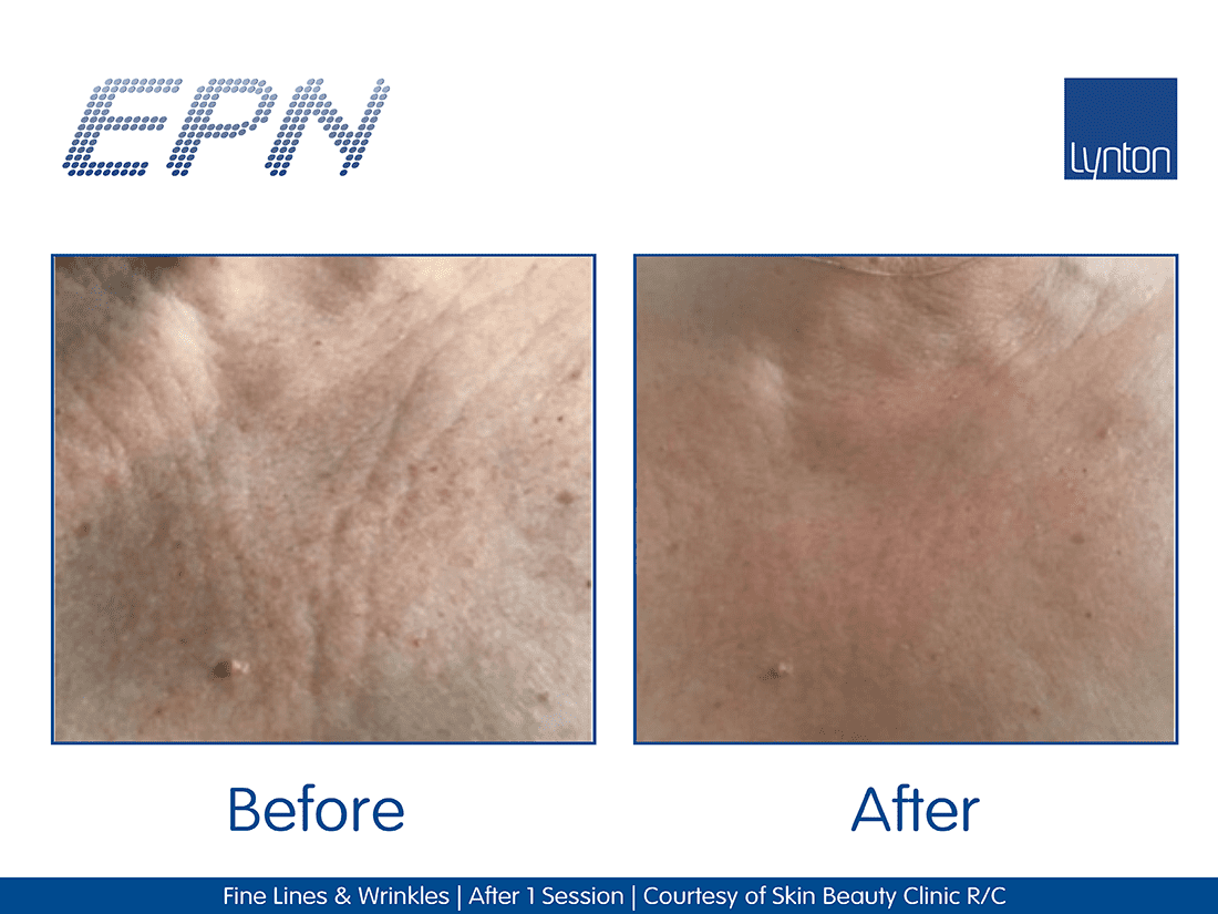 MICRONEEDLING EPN™