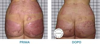 ICOONE LASER MED