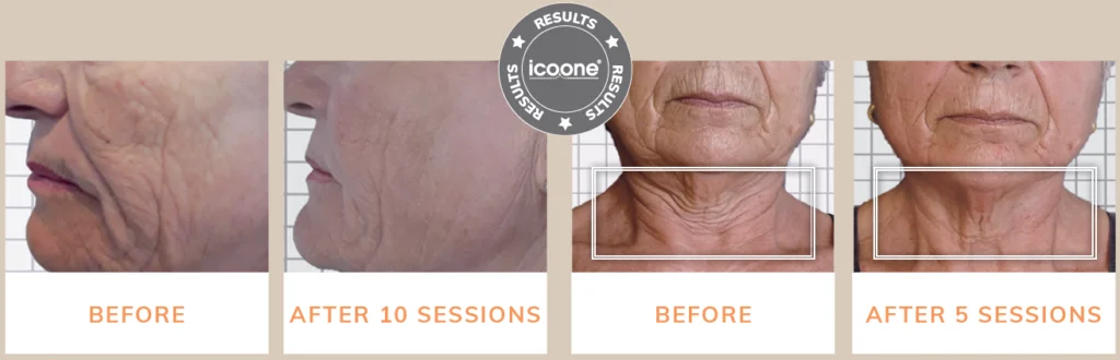 ICOONE LASER MED ICOONE LASER MED