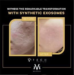 EXOZOMI V-TECH