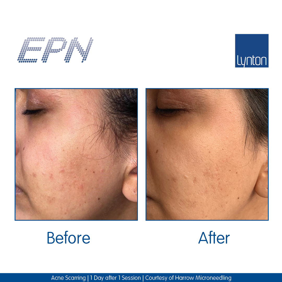 MICRONEEDLING EPN™
