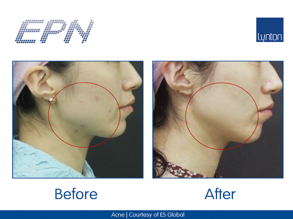MICRONEEDLING EPN™