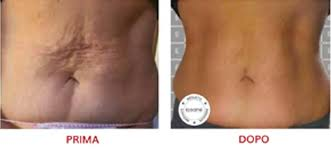 ICOONE LASER MED