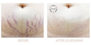 ICOONE LASER MED